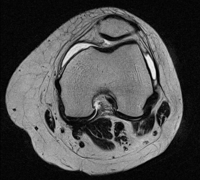 File:Bucket handle tear - medial meniscus (Radiopaedia 79028-91942 Axial T2 17).jpg