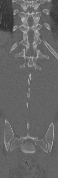 File:Burst fracture - T12 with conus compression (Radiopaedia 56825-63647 Coronal bone window 32).png
