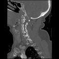 C1 anterior arch (plough) fracture - type 1 (Radiopaedia 76181-87720 Sagittal bone window 69).jpg