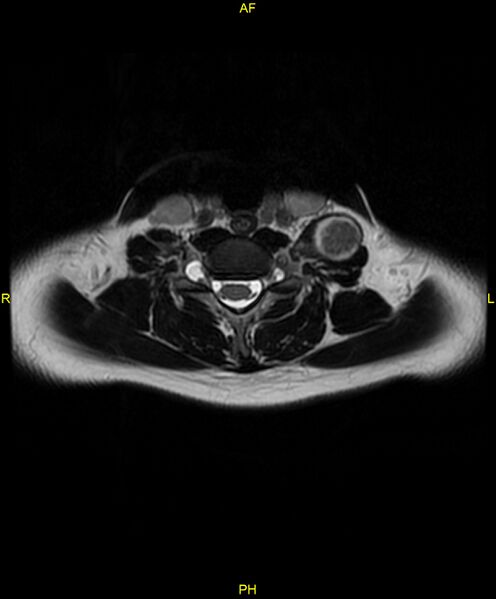 File:C5 nerve sheath tumor (Radiopaedia 85777-101596 Axial T2 53).jpg