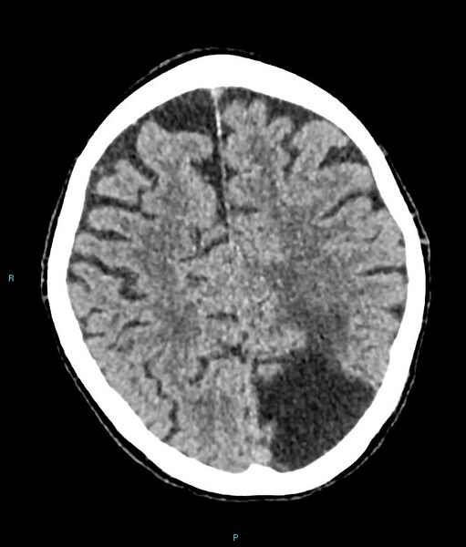 File:Calcified cerebral emboli from left ventricular thrombus (Radiopaedia 84420-99758 Axial non-contrast 31).jpg