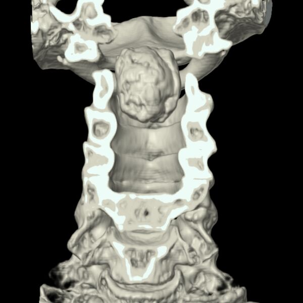 File:Calcified meningioma - cervical canal (Radiopaedia 70136-80171 3D-VR 2).jpg