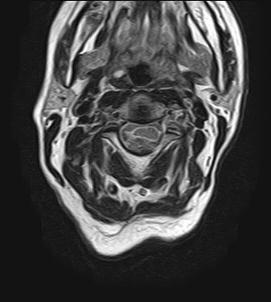 File:Calcified meningioma - cervical canal (Radiopaedia 70136-82468 Axial T2 11).jpg
