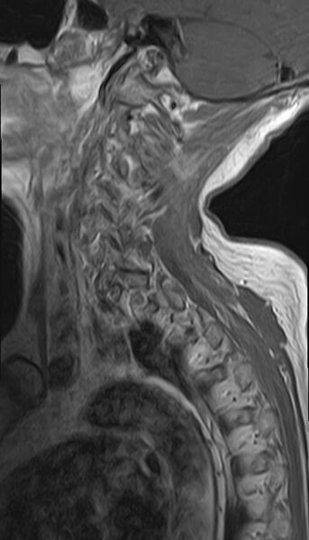File:Calcified meningioma - cervical canal (Radiopaedia 70136-82468 Sagittal 13).jpg