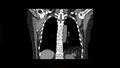 Calcified spleen (Radiopaedia 60952-68768 Coronal non-contrast 5).jpg