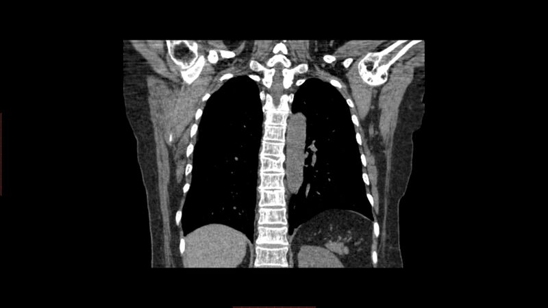 File:Calcified spleen (Radiopaedia 60952-68768 Coronal non-contrast 5).jpg