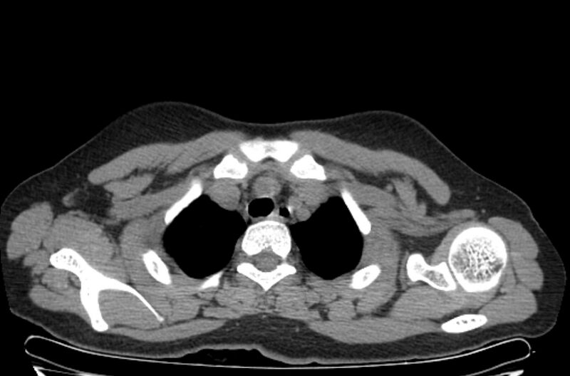 File:Cannonball metastases - uterine choriocarcinoma (Radiopaedia 70137-80173 Axial non-contrast 7).jpg