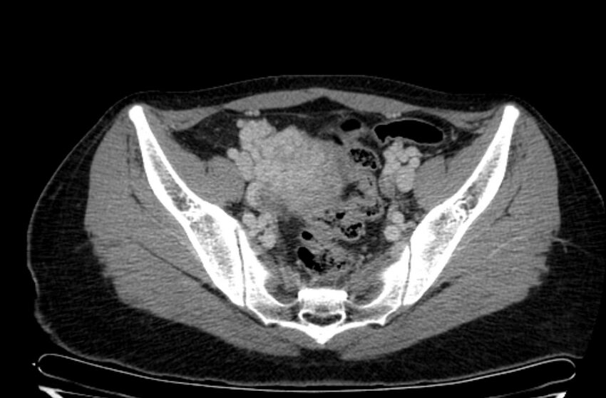 Cannonball metastases - uterine choriocarcinoma (Radiopaedia 70137-80174 A 15).jpg