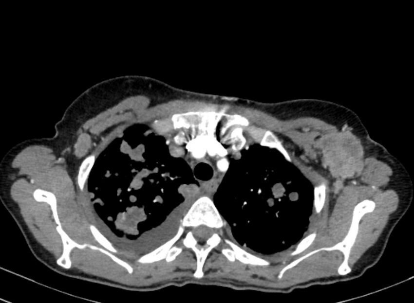 Cannonball metastases from breast cancer (Radiopaedia 91024-108569 A 30).jpg