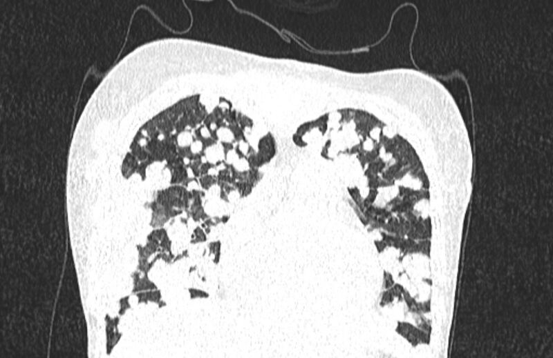 File:Cannonball metastases from breast cancer (Radiopaedia 91024-108569 Coronal lung window 38).jpg