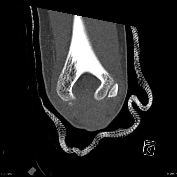 File:Capitellum fracture (Radiopaedia 23352-23426 Coronal bone window 13).jpg