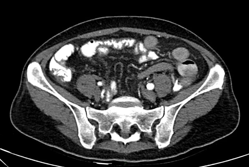 File:Carcinoid mesenteric tumor complicated by chylous ascites (Radiopaedia 76312-88926 A 52).jpg