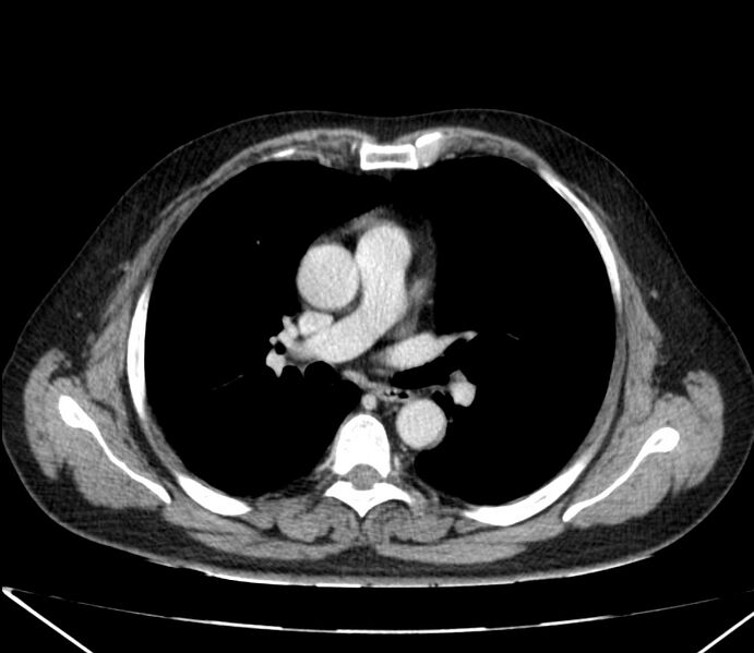 File:Carcinoid tumor with hepatic metastases (Radiopaedia 22651-22670 C 15).jpg