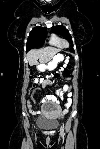File:Carcinoma of uterine cervix (Radiopaedia 85861-101700 C 9).jpg