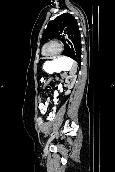 File:Carcinoma of uterine cervix (Radiopaedia 85861-101700 D 58).jpg