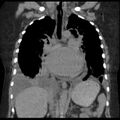 Cardiogenic pulmonary edema (Radiopaedia 29213-29609 Coronal non-contrast 22).jpg