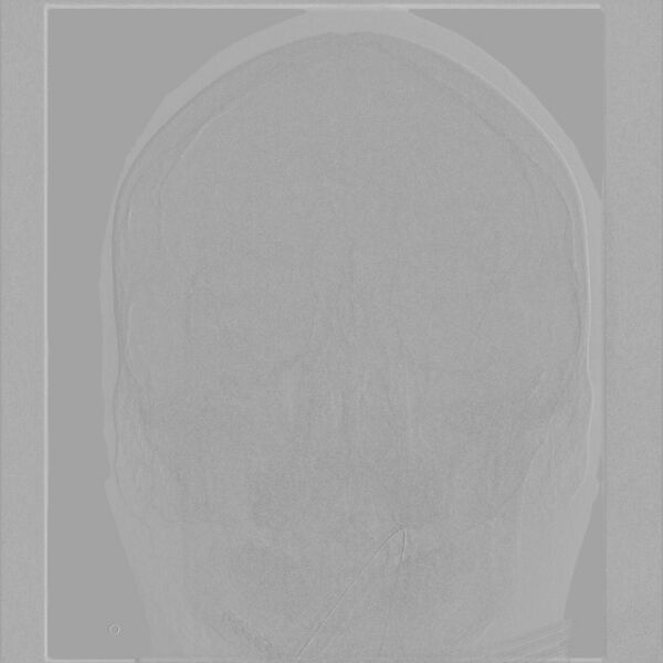 File:Caroticocavernous fistula - direct (Radiopaedia 61660-69666 A 5).jpg