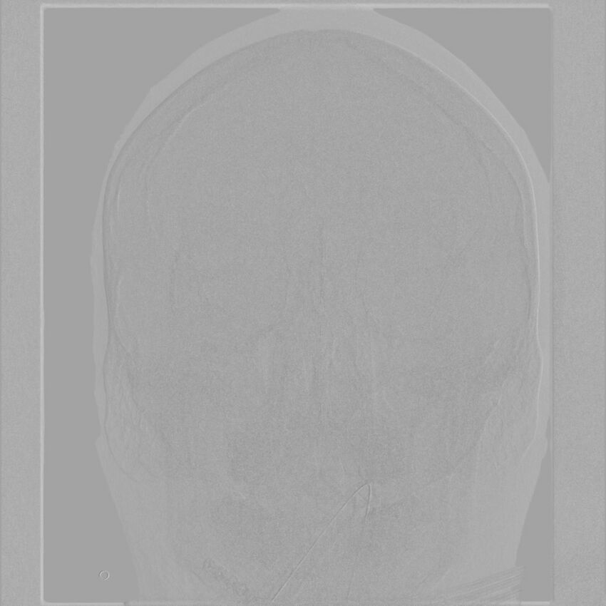 Caroticocavernous fistula - direct (Radiopaedia 61660-69666 A 5).jpg