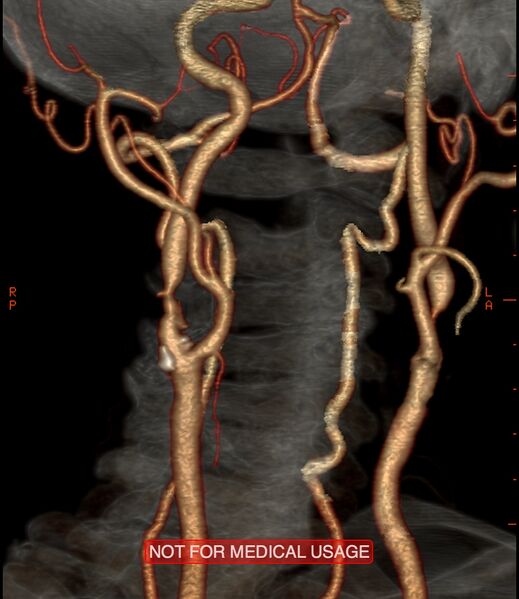 File:Carotid artery stenosis (Radiopaedia 28786-29086 A 13).jpg