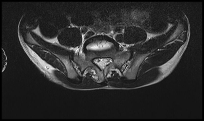 File:Caudal regression syndrome - type 1 (Radiopaedia 52113-57982 Axial T2 2).jpg