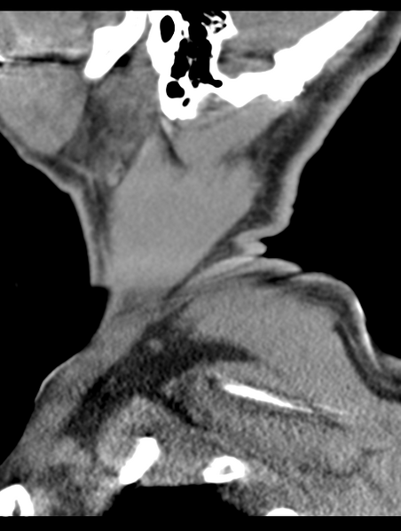 File:Cavernoma of cervical cord (Radiopaedia 50838-56346 B 3).png