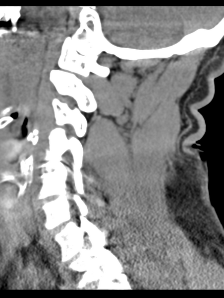 File:Cavernoma of cervical cord (Radiopaedia 50838-56346 B 51).png