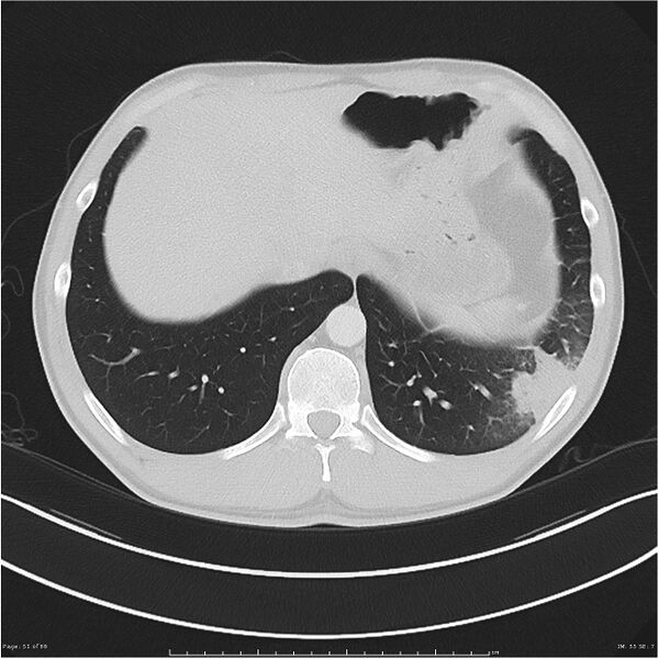 File:Cavitating lung cancer (Radiopaedia 25796-25945 Axial lung window 51).jpg