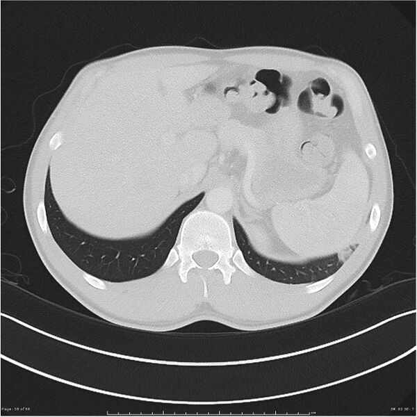 File:Cavitating lung cancer (Radiopaedia 25796-25945 Axial lung window 58).jpg