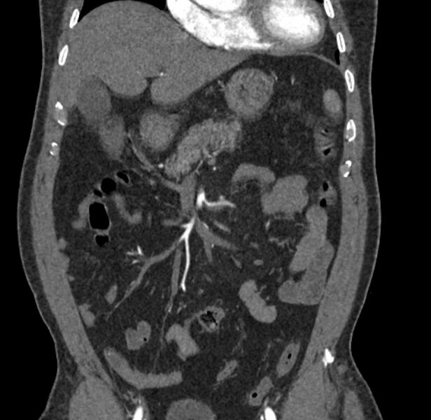 File:Celiac artery dissection (Radiopaedia 52194-58080 C 12).jpg