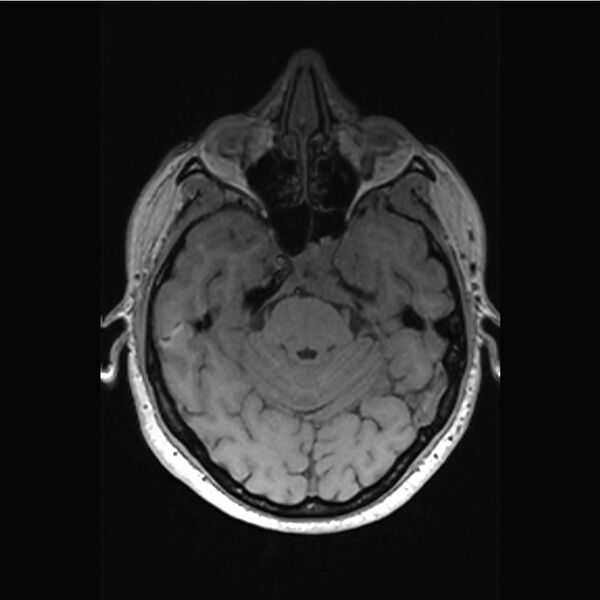 File:Central base of skull meningioma (Radiopaedia 53531-59549 Axial T1 11).jpg