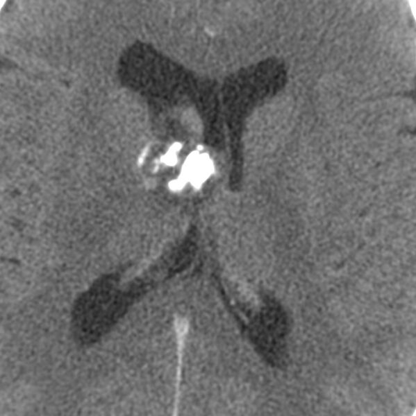 File:Central neurocytoma (Radiopaedia 68725-78432 C 15).jpg