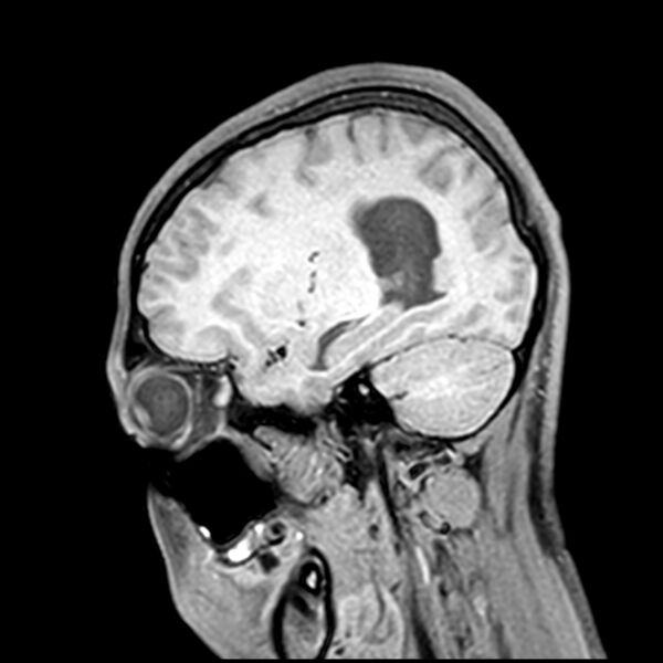 File:Central neurocytoma (Radiopaedia 79320-92380 Sagittal T1 182).jpg