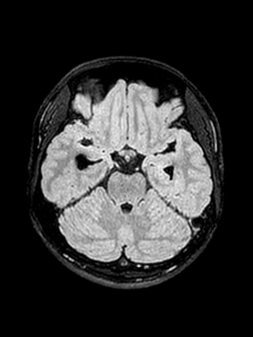 Central neurocytoma (Radiopaedia 79320-92381 Axial FLAIR 112).jpg