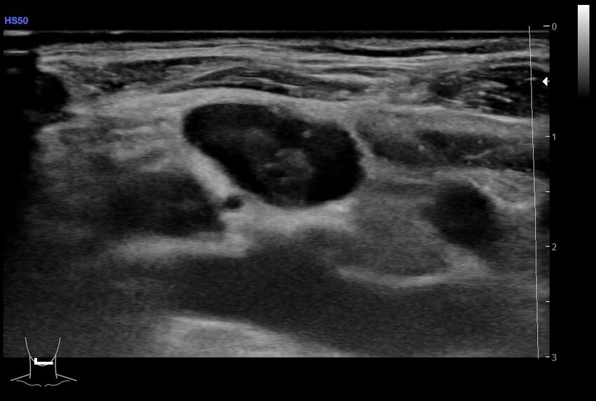 Central venous catheter-related thrombosis (Radiopaedia 61135-69025 Transverse 32).jpg