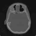 Cerebellar abscess secondary to mastoiditis (Radiopaedia 26284-26413 Axial bone window 80).jpg