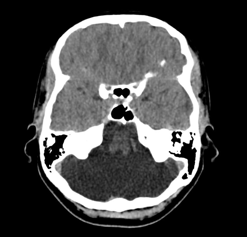 Cerebellar agenesis (Radiopaedia 30203-30817 Axial non-contrast 11).jpg