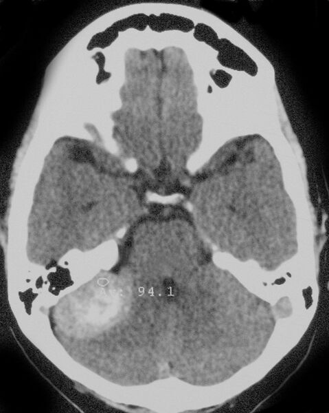 File:Cerebellopontine angle meningioma (Radiopaedia 2597-6294 B 1).jpg
