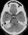 Cerebellopontine angle meningioma (Radiopaedia 2597-6294 B 1).jpg
