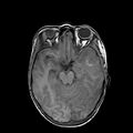 Cerebral abscess post cardiac surgery (Radiopaedia 27244-27420 Axial T1 9).jpg