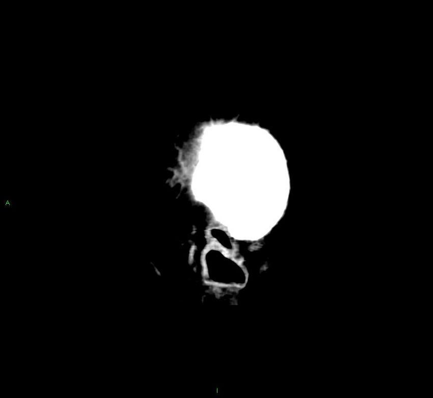 Cerebral amyloid angiopathy-associated lobar intracerebral hemorrhage (Radiopaedia 58376-65511 C 51).jpg