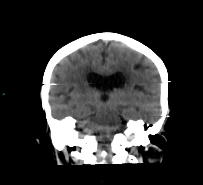File:Cerebral amyloid angiopathy-associated lobar intracerebral hemorrhage (Radiopaedia 58377-65514 Coronal non-contrast 30).jpg