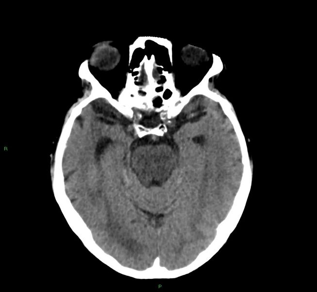 File:Cerebral amyloid angiopathy-associated lobar intracerebral hemorrhage (Radiopaedia 58530-65688 Axial non-contrast 33).jpg