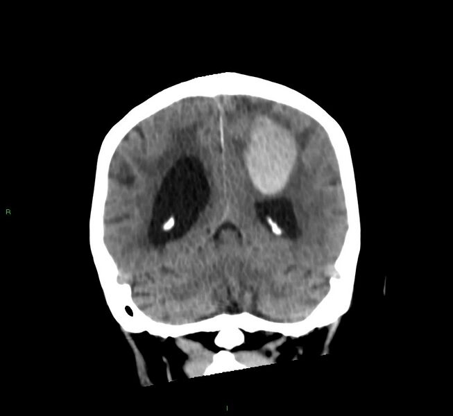 File:Cerebral amyloid angiopathy-associated lobar intracerebral hemorrhage (Radiopaedia 58530-65688 Coronal non-contrast 23).jpg