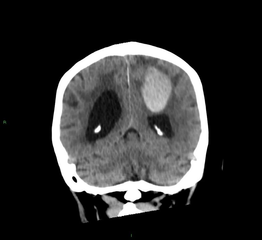 Cerebral amyloid angiopathy-associated lobar intracerebral hemorrhage (Radiopaedia 58530-65688 Coronal non-contrast 23).jpg