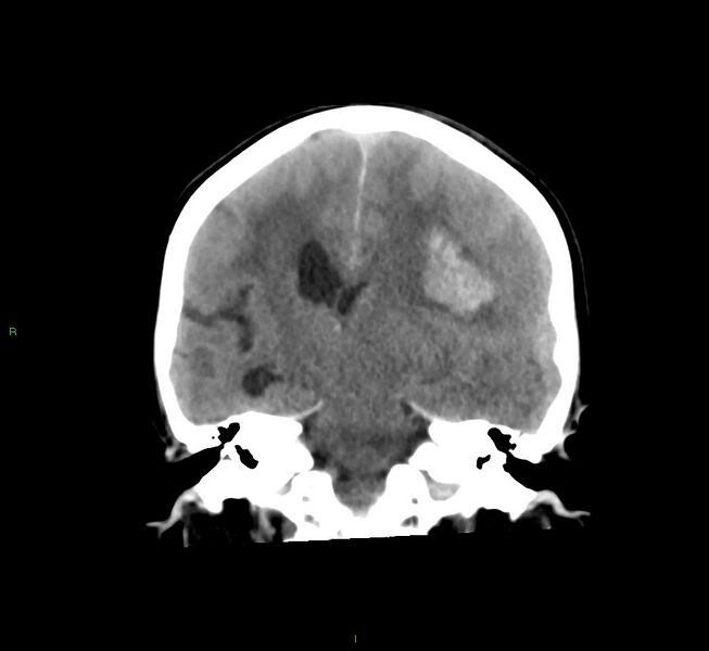 File:Cerebral amyloid angiopathy-associated lobar intracerebral hemorrhage (Radiopaedia 58561-65724 Coronal non-contrast 30).jpg