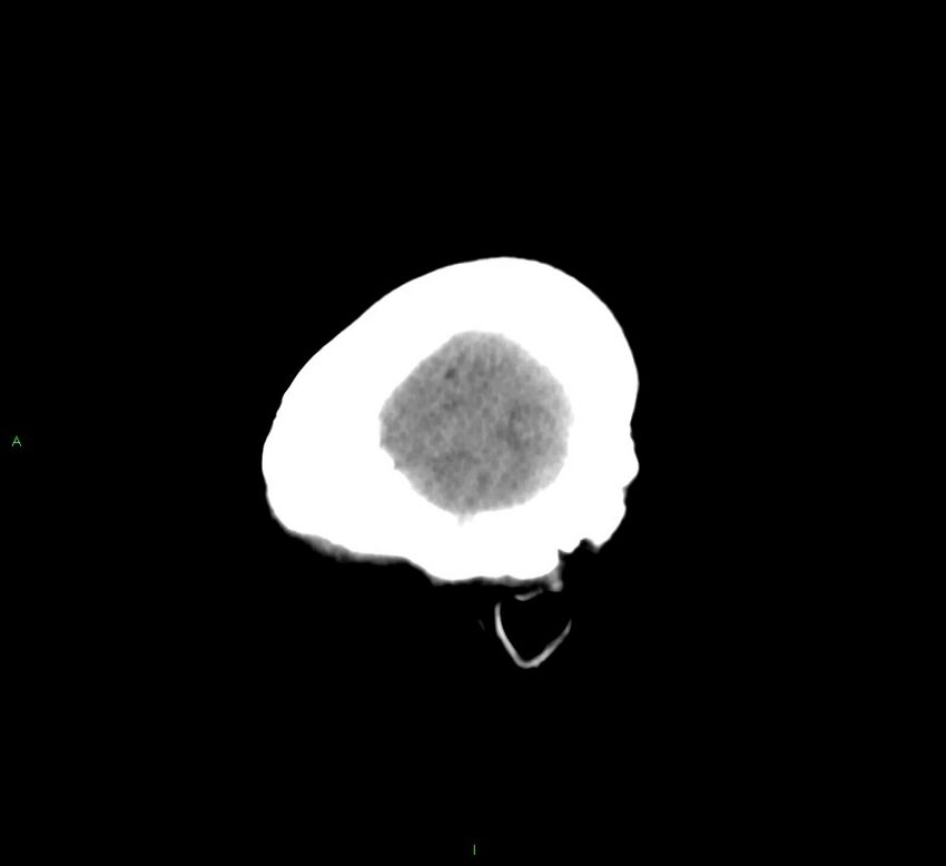 Cerebral amyloid angiopathy-associated lobar intracerebral hemorrhage (Radiopaedia 58563-65727 C 7).jpg
