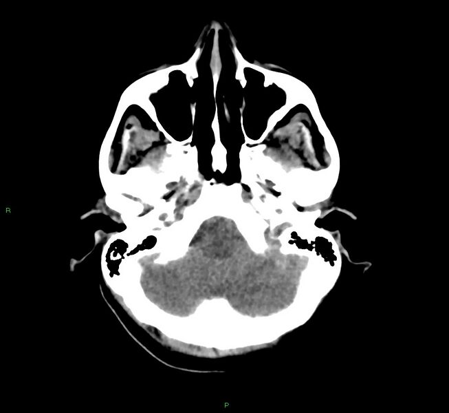 File:Cerebral amyloid angiopathy-associated lobar intracerebral hemorrhage (Radiopaedia 58566-65730 Axial non-contrast 43).jpg