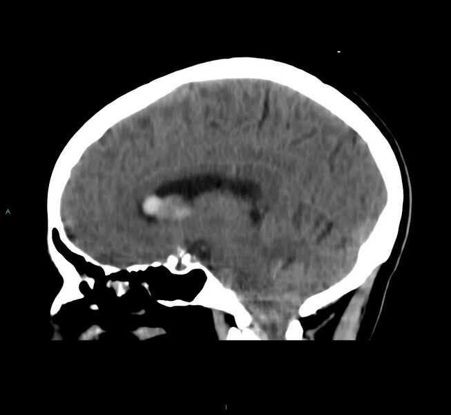 File:Cerebral amyloid angiopathy-associated lobar intracerebral hemorrhage (Radiopaedia 58566-65730 C 28).jpg