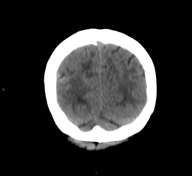 File:Cerebral amyloid angiopathy-associated lobar intracerebral hemorrhage (Radiopaedia 58566-65730 Coronal non-contrast 16).jpg