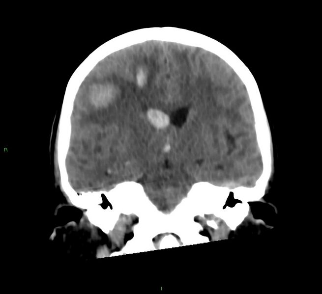 File:Cerebral amyloid angiopathy-associated lobar intracerebral hemorrhage (Radiopaedia 58566-65730 Coronal non-contrast 38).jpg